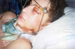 Accident injuries from fall