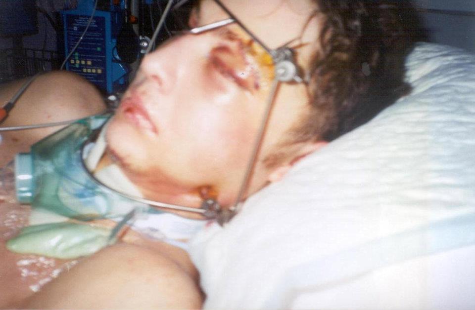 Accident injuries from fall from height